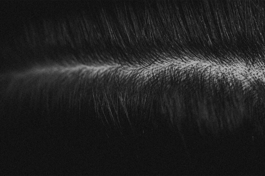 sem info microagulhamento capilar